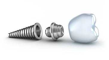close up of dental implant l dentist near me