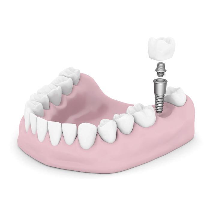 Diagram of a dental implant going in gums at The Dental Care Center