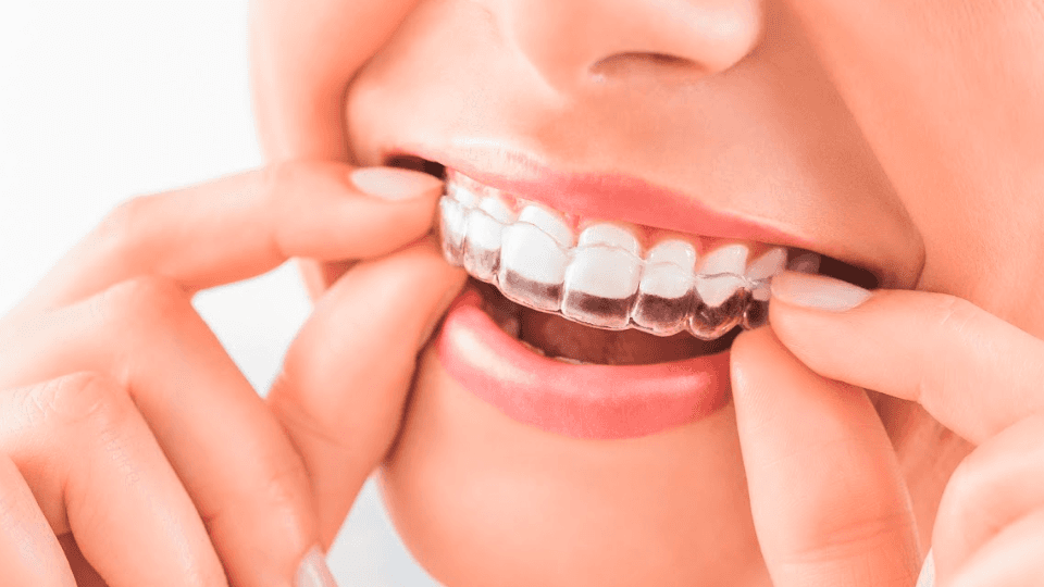 Can Invisalign Fix Overbites? Cosmetic Dentistry Van Nuys CA