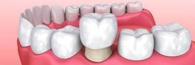 An Illustration of a Dental Crown in Van Nuys, CA