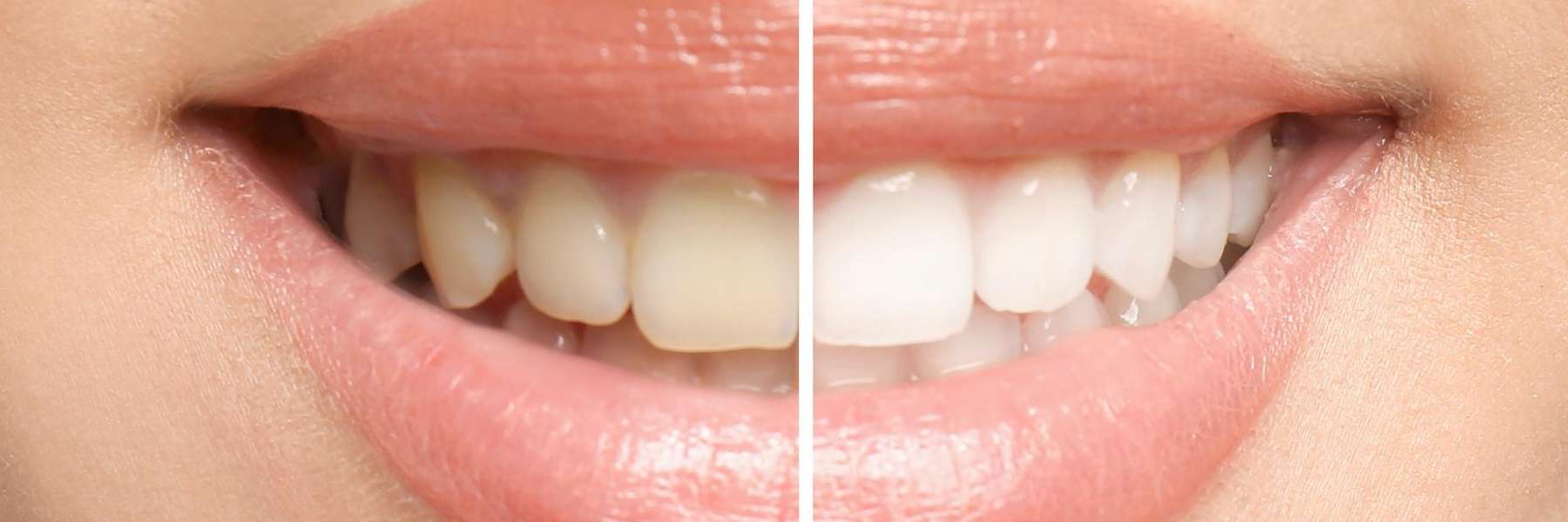 a photo collage of a teeth whitening result in van nuys. ca