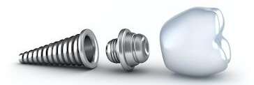 An illustration of a dental implant in The Dental Care Center, Van Nuys, California.