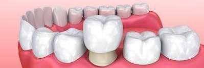 An illustration of dental crowns in The Dental Care Center, Van Nuys, California.