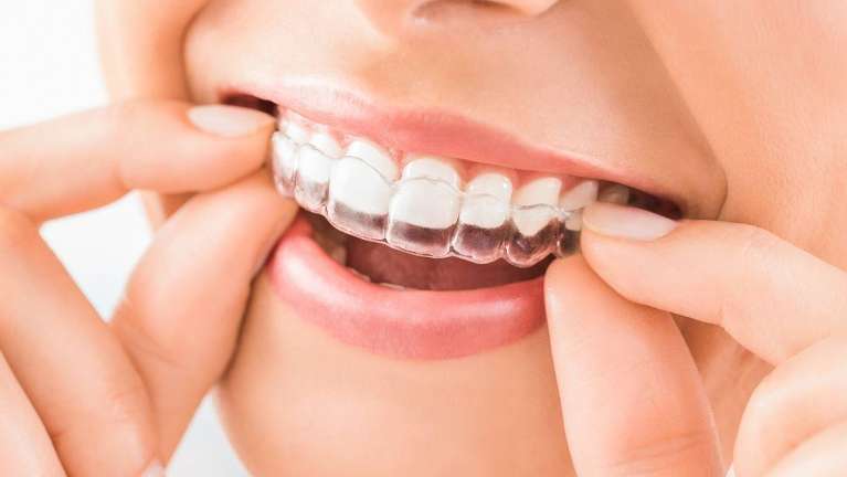 a female patient with Clear Braces in Van Nuys, CA