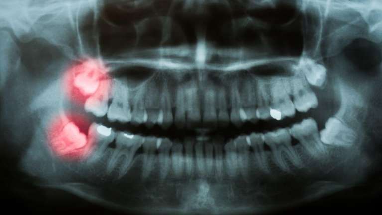 An X-Ray of wisdom teeth in Van Nuys
