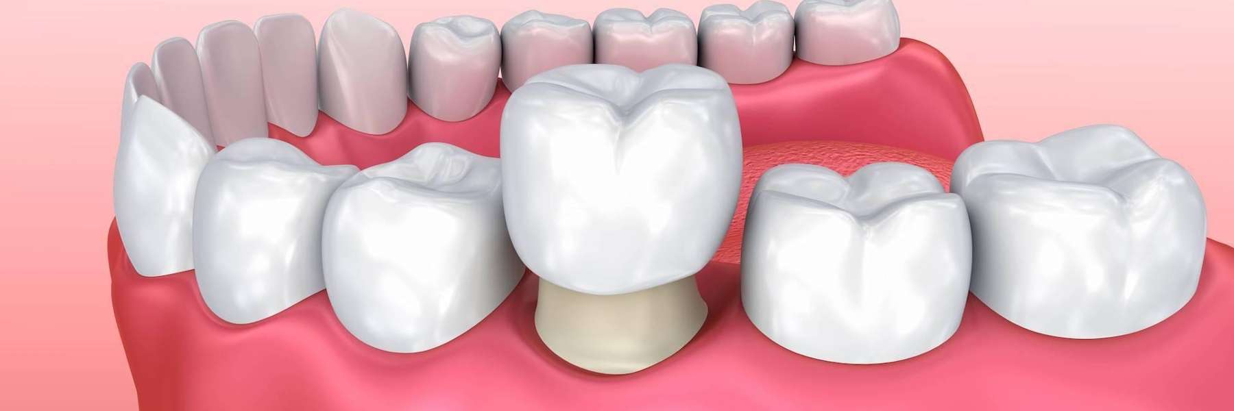 An illustration of Root Canal in Van Nuys. CA
