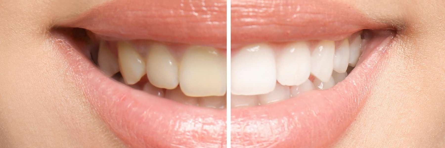 A picture of patient's teeth before and after whitening in Van Nuys, CA.