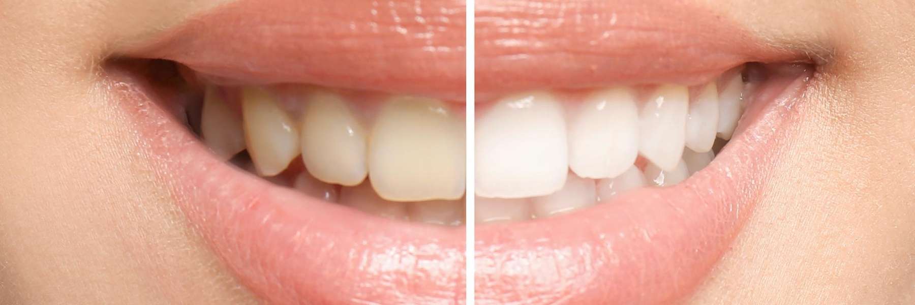 A picture of a patient before and after whitening in The Dental Care Center, Van Nuys, California