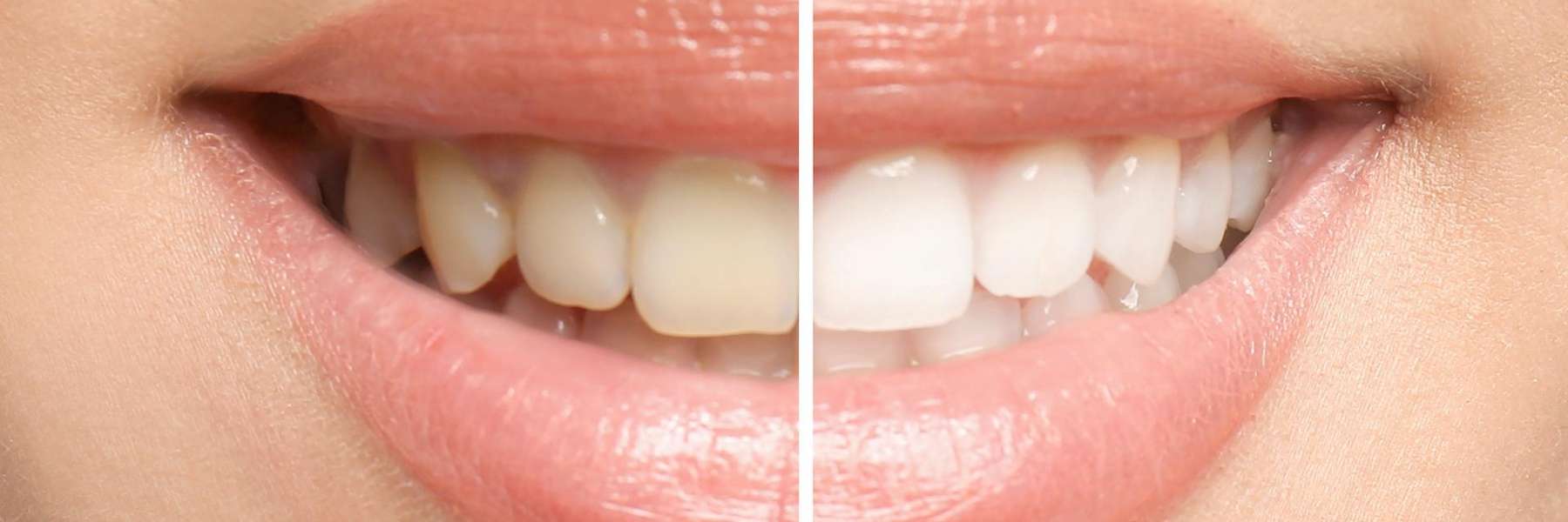 A before and after photo collage of a teeth whitening patient teeth in Van Nuys, CA