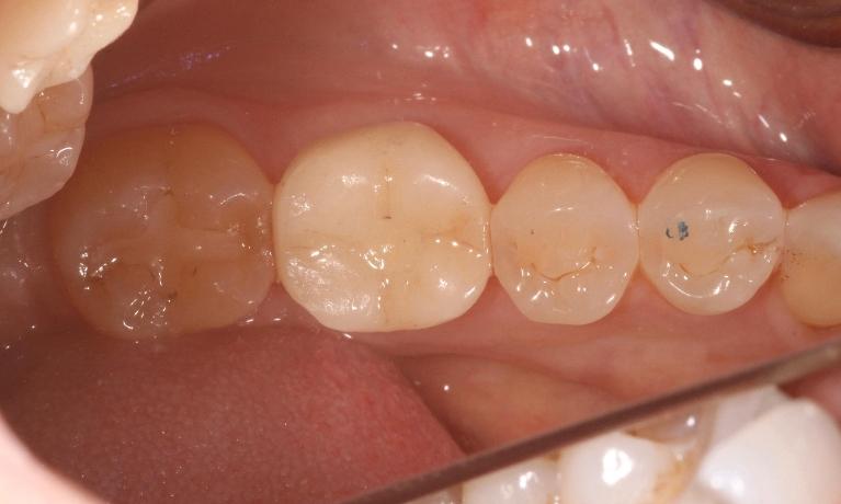 Extraction-and-Implant-After-Image