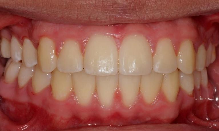 After image of straightened teeth with Invisalign in Van Nuys CA