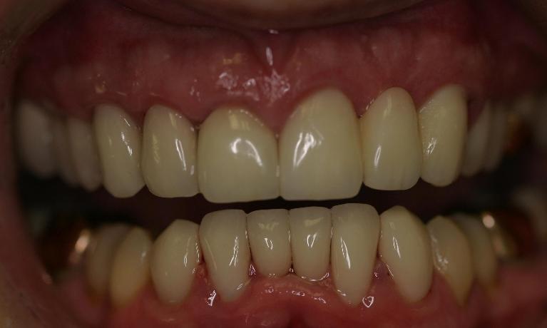 Crowns-After-Image