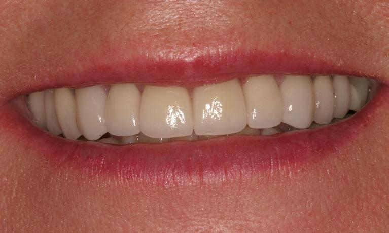 Veneers-and-Crowns-After-Image
