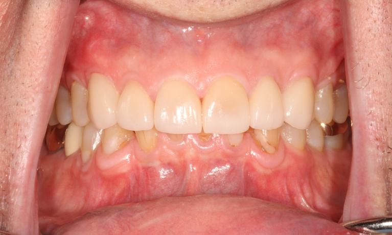 Night-Guard-and-Crowns-to-Correct-Grinding-After-Image