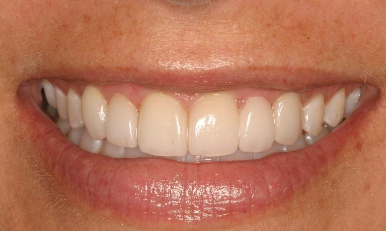 Periodontal-Treatment-Gives-Patient-A-Whole-New-Smile-After-Image