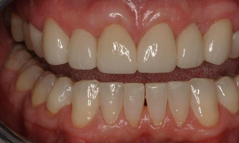Invisalign-and-Crowns-After-Image