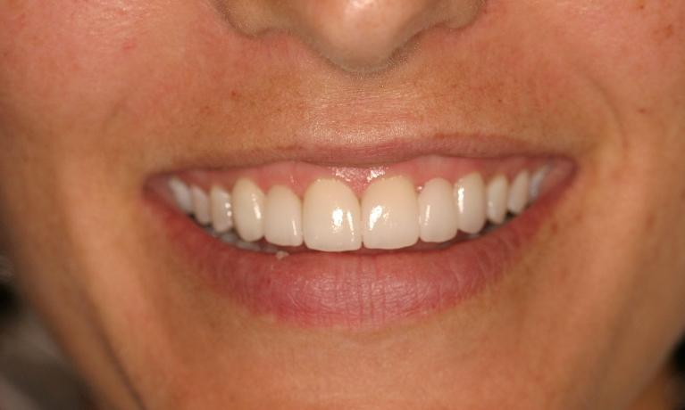 Smile-Makeover-After-Image