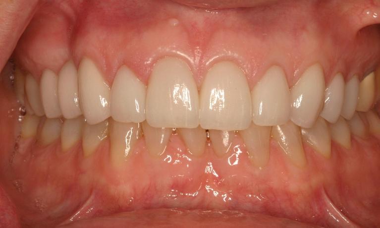 Close up of results from smile makeover in Van Nuys CA