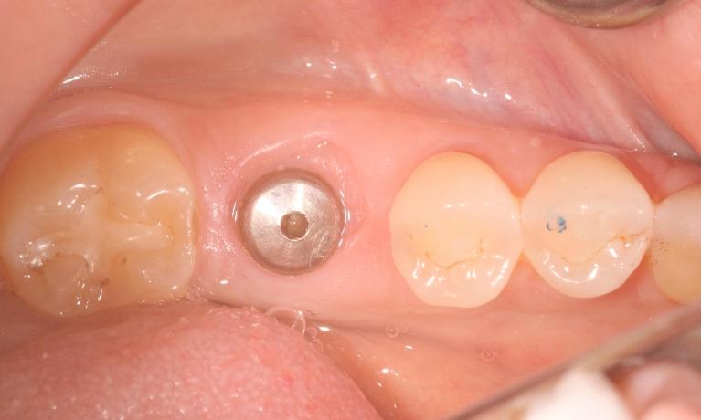 Extraction-and-Implant-Before-Image