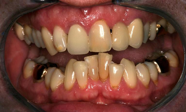 Crowns-Before-Image