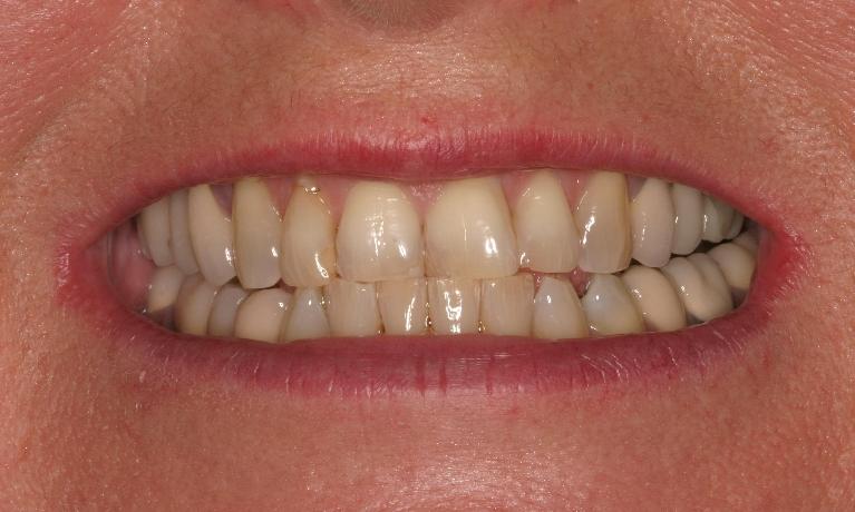 Veneers-and-Crowns-Before-Image