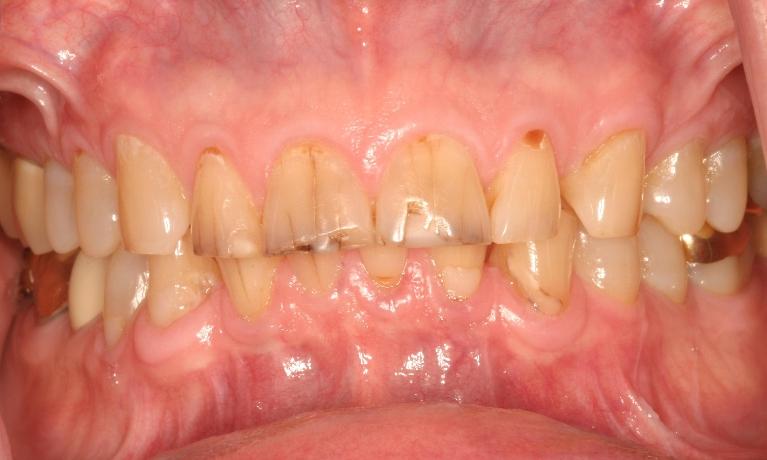 Night-Guard-and-Crowns-to-Correct-Grinding-Before-Image