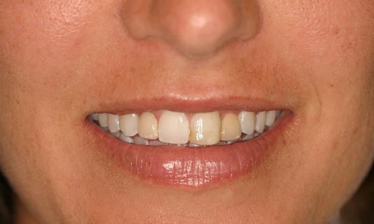 Restorations-of-Old-Crowns-Before-Image