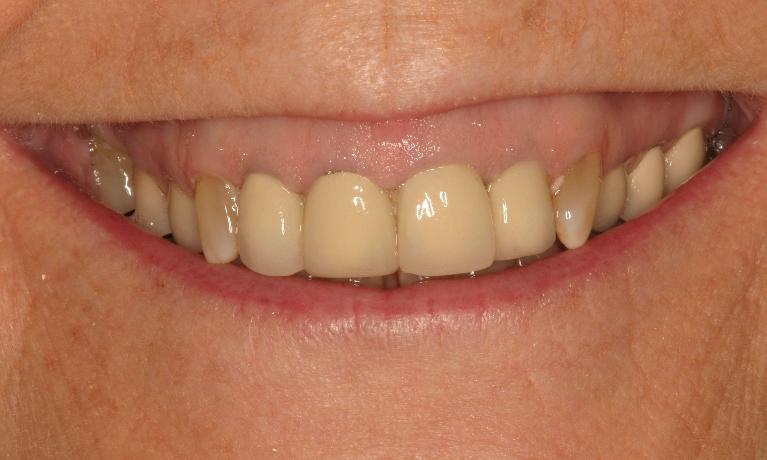 Periodontal-Treatment-Gives-Patient-A-Whole-New-Smile-Before-Image