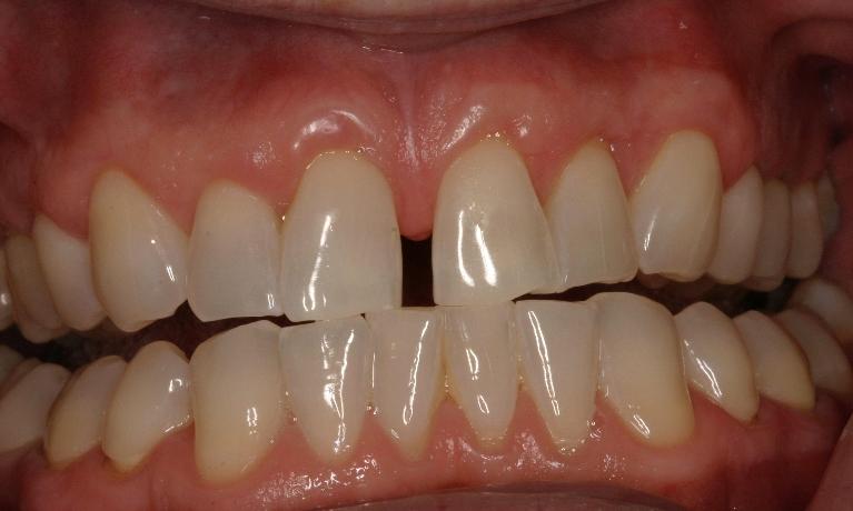 Invisalign-and-Crowns-Before-Image