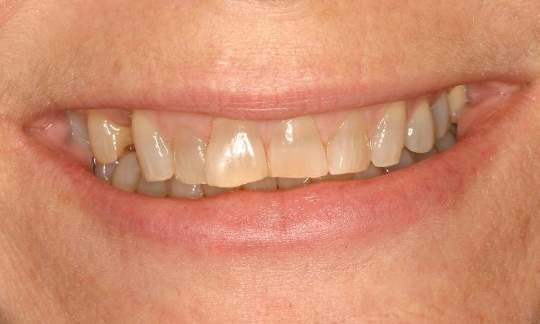 Smile-Makeover-Before-Image