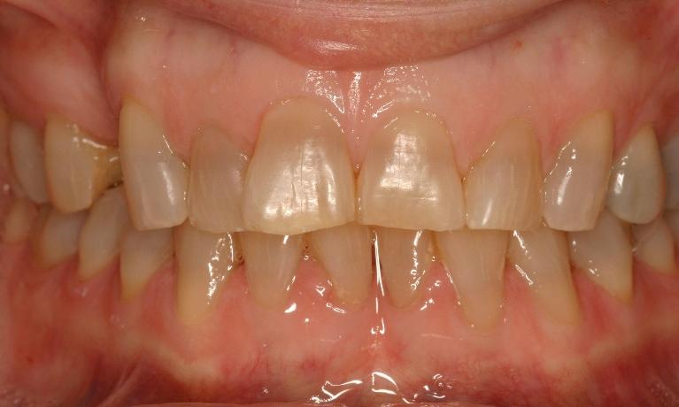 Close up of discolored and worn down teeth before smile makeover in 91405